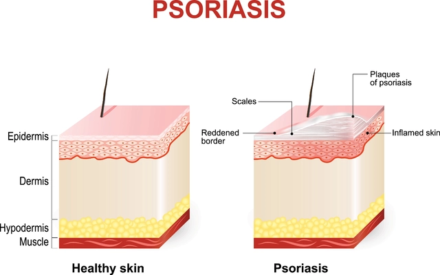 The Importance of Early Diagnosis and Treatment for Plaque Psoriasis